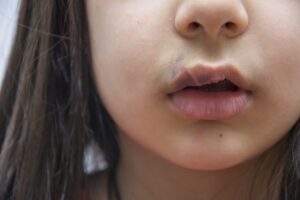 Comissão debate políticas públicas de atenção integral às pessoas com fissura labiopalatina – Notícias