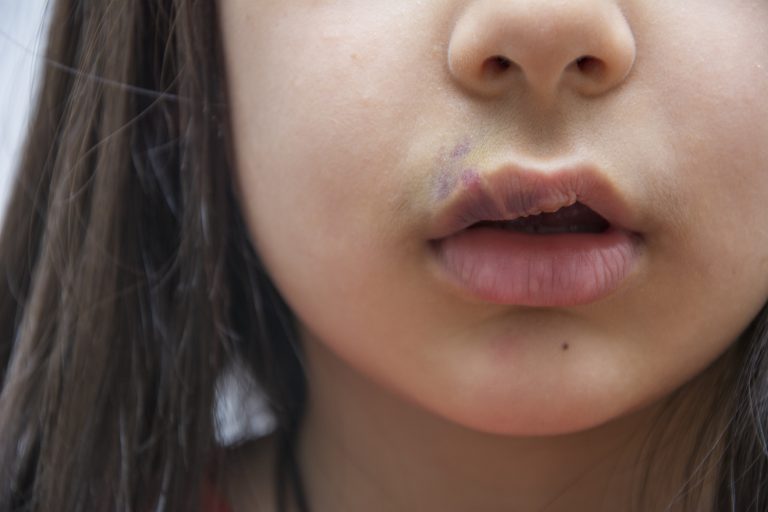 Comissão debate políticas públicas de atenção integral às pessoas com fissura labiopalatina – Notícias